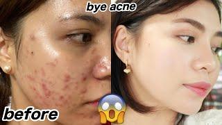 SKIN CARE ROUTINE FOR OILY ACNE PRONE SKIN
