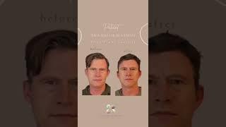 Deep Plane Facelift - The Kaplan Center for Plastic & Reconstructive Surgery NYC NJ #facelift