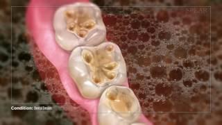 Dental Erosion