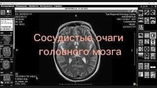 МРТ головного мозга. Сосудистые очаги. Разбор  случая с пояснениями врача МРТ.