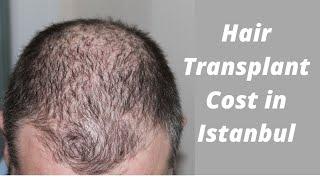 Hair Transplant in Istanbul, Hair Transplant Cost in Istanbul