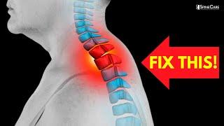 How to Fix a Neck Hump at Home