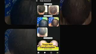 Traya Hair Treatment Review After 5 Months #traya #shortsfeed #ytshorts