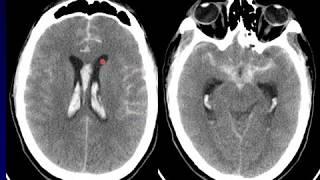 Introduction to Neuroradiology Part 3