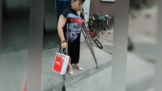 The beautiful woman with polio walks on crutches #polio #disabled