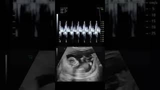 This is What a Baby's Heartbeat Sounds Like During an Ultrasound #science #natal #shorts