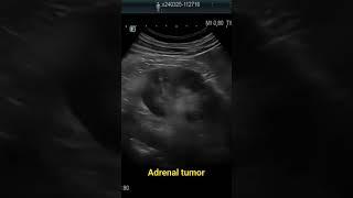 adrenal tumor#ultrasound #imaging #medicalimaging #learning #kidney