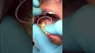 Extraction of the 8th tooth or "wisdom" tooth