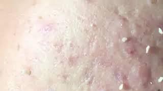 loan nguyen acne removal