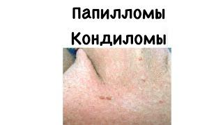 Папилломы. Кондиломы. Сыпь. #подготовкакusmle#сыпь#папилломы#кондиломы#вируспапииломычеловека