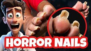   A Patient Came in with 2-INCH TOENAILS.   Watch What Happened Next!