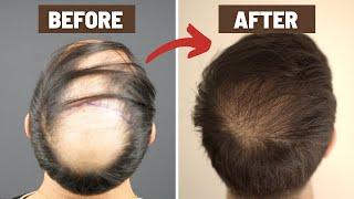 1 Year CROWN Hair Transplant Journey - Before & After (Trust The Process)