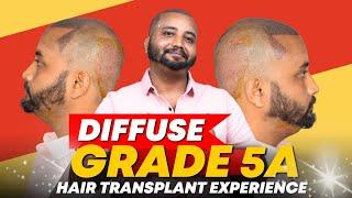 Hair Transplant in Jabalpur | Best Results & Cost of Hair Transplant in Jabalpur