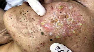 Big Cystic Acne Blackheads Extraction Blackheads & Milia, Whiteheads Removal Pimple Popping # 1576