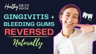 How to STOP Bleeding Gums (Home Remedies That Work!) | Jennifer Fugo