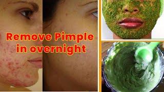 Remove pimple in overnight permanently | no more pimples on face | Neem Face pack for acne # Shorts