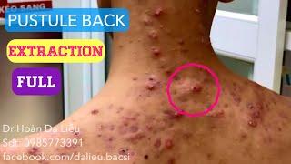 Mụn trứng cá mủ lưng cực nặng|Dermatologist,pimples,whitehead,acne conglobata pustule extraction ful