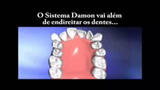 Claro dental - Prof Dr Marcelo Fabre Carinhena Damon System