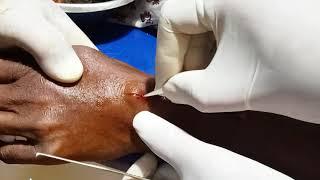 Ganglion cyst removed || #whatilearntoday