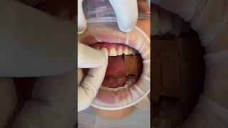 Minimal Prep Porcelain Veneers by Dr. Tejas Patel! Expert Cosmetic Dentist In Austin, TX