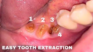 Very Satisfying Tooth Extraction | Dokter Gigi Tri Putra