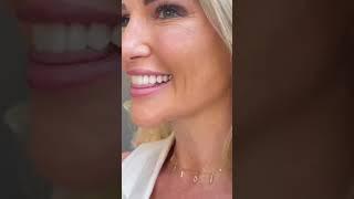 Veneers smile makeover #cosmeticdentistry #porcelainveneers #dentalveneers