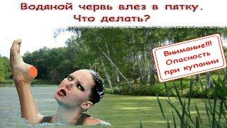 Водяной червь влез в пятку. Что делать?