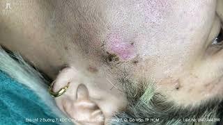 Big Cystic Acne Blackheads Extraction Blackheads & Milia, Whiteheads Removal Pimple Popping