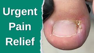 Emergency Ingrown Nail Removal – Instant Relief!