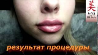 Увеличение губ в Мэй SPA Studio