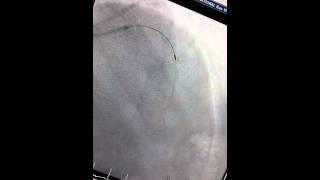 Rotablation angioplasty of a Calcified 'Widow maker's' artery! ️ (Dr Binoy John) Still more Rota!