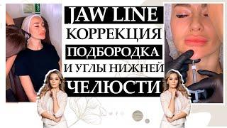 Jaw Line. Контурная пластика филлерами + коррекция подбородка и углы нижней челюсти.