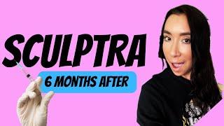 Sculptra- 6 Months Before/After 4 Vials. Overview of My Experience #sculptra #collagen