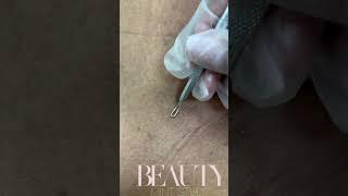 Ingrown Hair Removal Part 2