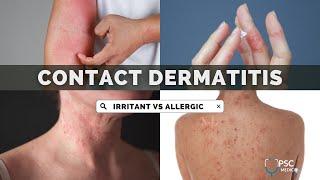 Irritant Contact Dermatitis vs Allergic Contact Dermatitis | Dermatology | UPSC MEDICO