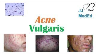 Acne Vulgaris | Causes, Pathogenesis, Influencing Factors, Diagnosis, Treatment and Complications