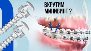 Почему [в 82% клинических случаев] ортодонты применяют минивинты