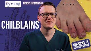 How To Get Rid Of CHILBLAINS (Pernio): Itchy Sores On Your Fingers And Toes - Doctor Explains