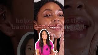 How To Treat Acne On Skin Of Color