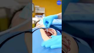 Scissors Left Inside Stomach for 18 Years! Unbelievable True Story | 3D Animation #shorts #trending