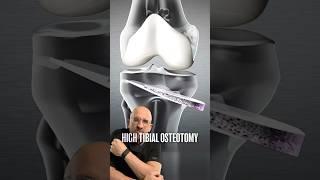 Discover The Surgery That Saved Goggins Knee⁉️