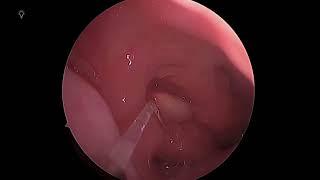 Diode Laser Ablation Tubal Tonsils