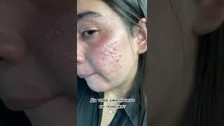 #болтушка #акне #какизменитьсебя #fup #топ #прыщи #доктор #skincare