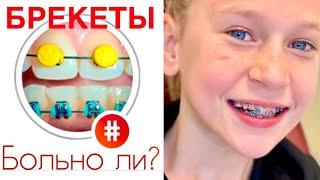 6 этапов установки БРЕКЕТОВ. БОЛЬНО ЛИ? / MARGOLANDIA