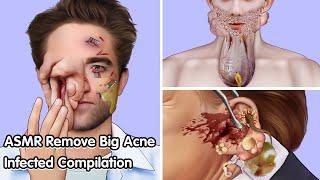 ASMR Remove Big Acne Infected Eyes Compilation - Deep Cleaning Animation