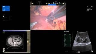 BK Medical: Robotic Assisted Partial Nephrectomy (RAPN) by Dr. James R. Porter