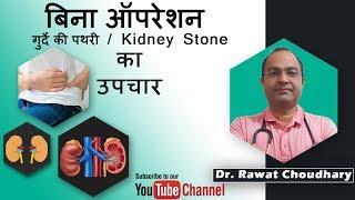 बिना ऑपरेशन के गुर्दे की पथरी का उपचार | Kidney Stone treatment without surgery