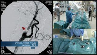 Баллонная ангиопластика и стентирование сонной артерии