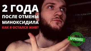 Миноксидил зло? Реально ли вырастить густую бороду? 2 года после отмены миноксидила. История успеха