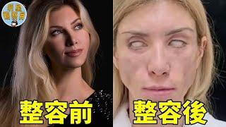 成為選美皇后還不滿足，還要花鉅資整容，結果美女變僵屍後悔來不及｜整容｜選美皇后｜明星觀察員